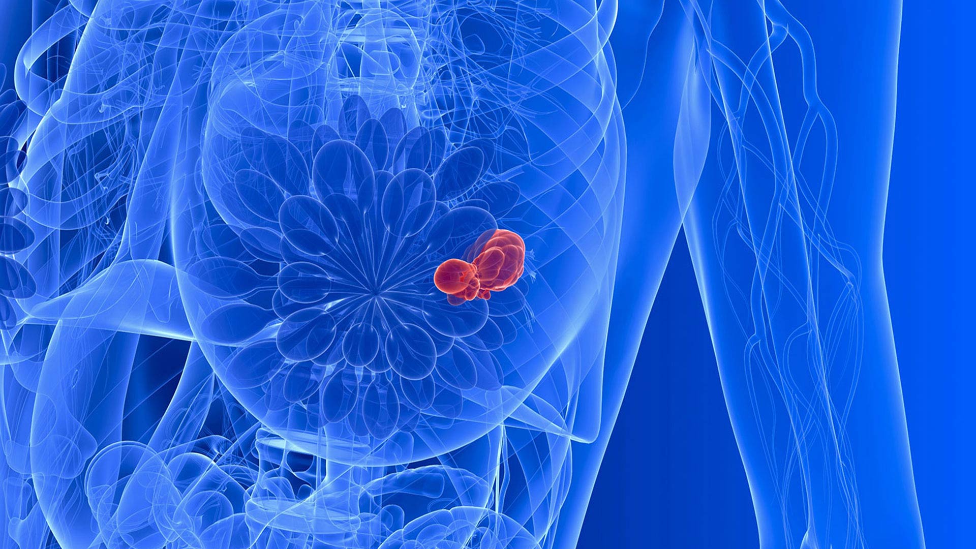 Programul de reconstrucţie a sânului “merge prost”