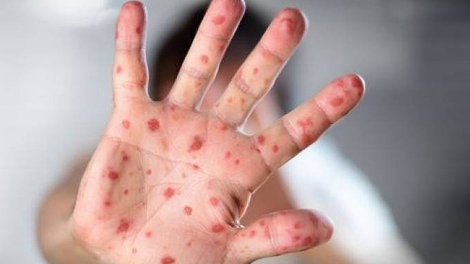 Medicii sunt în alertă! Un alt val de epidemie de rujeolă va izbucni!