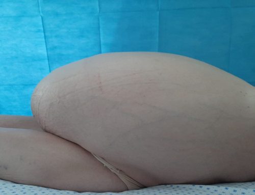 Tumoră de 40 de kilograme, extirpată de medicii de la Spitalul Militar Central